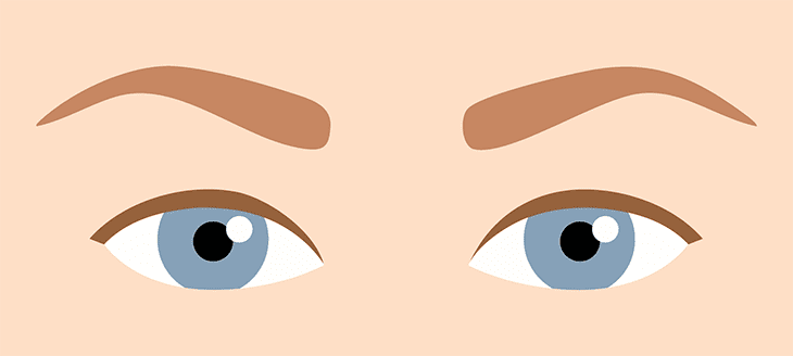 Illustration Augen nach Pupilloplastik